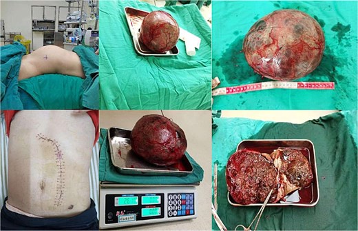 Gross image of the resected left renal mass.