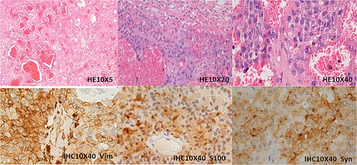 Immunohistochemical analysis of the left renal mass. The tumor is situated within the renal parenchyma, compressing and displacing adjacent renal tubules with associated atrophy. Histologically, it demonstrates nested and papillary growth patterns within a richly vascularized stroma. High-power examination reveals tumor cells with vacuolated or eosinophilic cytoplasm, prominent small nucleoli, and rare mitotic figures. Immunohistochemical staining shows diffuse cytoplasmic positivity for Vimentin (Vim), S100, and Synaptophysin (Syn).