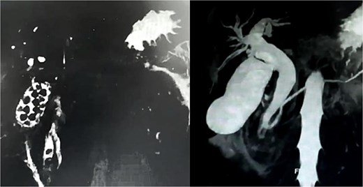 Magnetic resonance cholangiography reconstruction (360°) demonstrating the presence of multiple gallbladder stones and two embedded in the distal common bile duct.