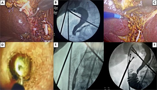 Surgical procedure. (A) Opening of the cystic duct. (B) Initial cholangiography showing no passage into the duodenum and passage into the main pancreatic duct. (C) Introduction of a transcystic SpyGlass over a hydrophilic guidewire. (D) Stone lodged in the distal common bile duct, ready for fragmentation. An electrohydraulic lithotripsy probe is visible, aimed at the center of the stone. (E) Sphincteroplasty by balloon dilation. A notch is visible, coinciding with the sphincter of the Oddi area. (F) Final cholangiography showing free passage of contrast into the duodenum, with no filling defect.