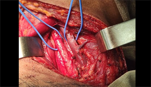 Intraoperative exposure of zone II neck following gunshot injury. This image demonstrates the surgical field during exploration of a penetrating neck wound in zone II on the right side. An oblique cervical incision was made, and the platysma and sternocleidomastoid muscle were dissected to expose the carotid sheath. Key vascular structures, including the common carotid artery and internal jugular vein, were visualized and confirmed intact. No injury to the esophagus, trachea, or vertebral bodies was identified. The operative site is shown prior to layered closure.