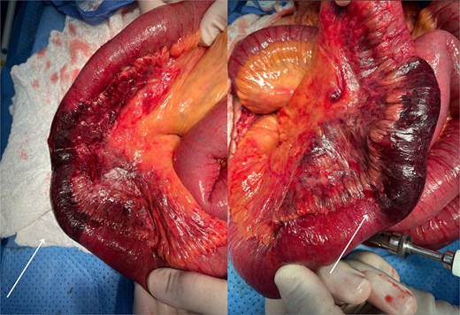 Ischemic small bowel intraoperatively revealed during exploratory laparotomy. Intraoperative view of the small intestine demonstrating extensive ischemic changes involving ~150–180 cm of jejunum and proximal ileum. The affected bowel segments appear dusky with patchy white serosal lesions. The mesentery shows congestion and edema, without evidence of torsion or thrombosis. These findings were consistent with transmural infarction secondary to vasculitis, later confirmed by histopathology. Healthy proximal and distal margins were established prior to resection and anastomosis.