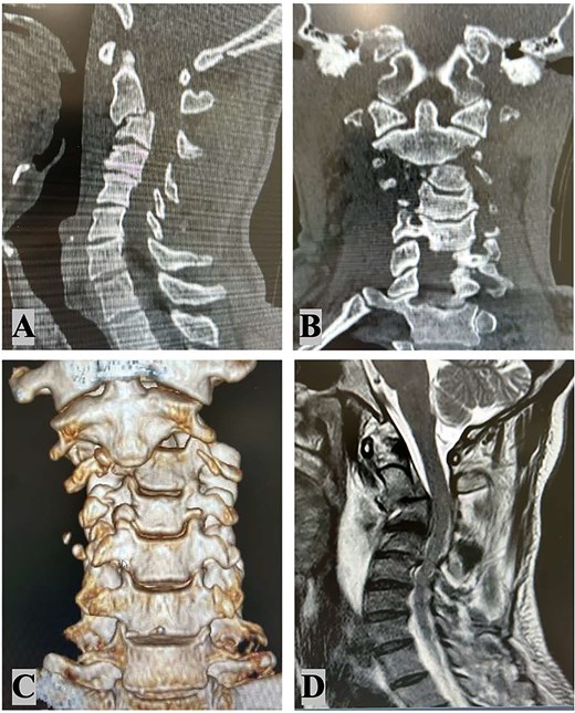 Radiological findings: Cervical spine sagittal computed tomography scan (A); cervical spine coronal CT scan (B) 3D coronal CT scan (C); MRI – C2–C3 subluxation with right lateral listhesis, where the C2 body was positioned on the right lateral aspect of C3 (D).