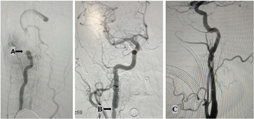 Angiography findings: Total occlusion of left vertebral artery (A); right internal carotid artery dissection shows an intimal flap and thrombi, along with significant hemodynamic changes. These findings are consistent with arterial dissection. (B); left internal carotid artery dissection shows irregularities in the distal cervical internal carotid artery and the left petrous artery, featuring an intimal flap in the lumen and filling defects from thrombi. These changes result from the dissection (C).