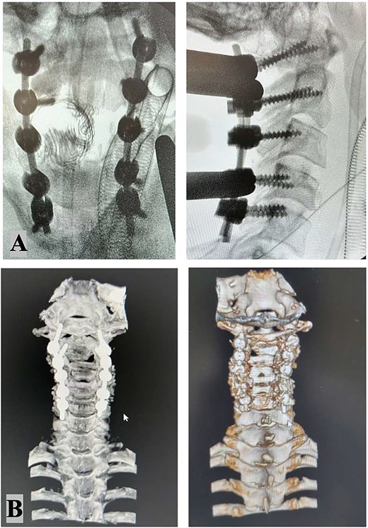 Intraoperative X-ray: Stable fixation and proper alignment of the cervical spine after C1–2–3–4–5 bilateral screw placement (A). Postoperative CT scan imaging confirmed successful realignment and structural integrity (B).