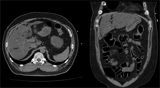 Noncontrast abdominopelvic CT revealed multifocal air foci in the liver and mesenteric vessel, suggesting portal vein and mesenteric vein gas.