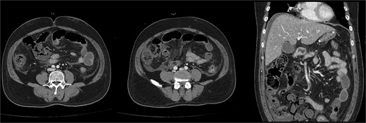 Follow-up dynamic liver CT revealed decreased wall enhancement, mural air densities in the distal small bowel and ascending colon compared to the previous noncontrast abdominopelvic CT.