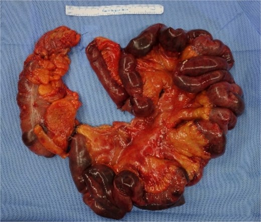 Resected small bowel.