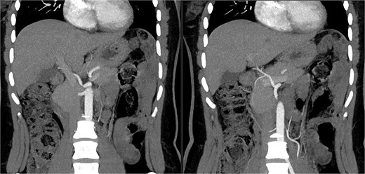 CT angiogram showing the celiac trunk giving rise to the left gastric artery and splenic artery, along with the hepatomesenteric trunk.
