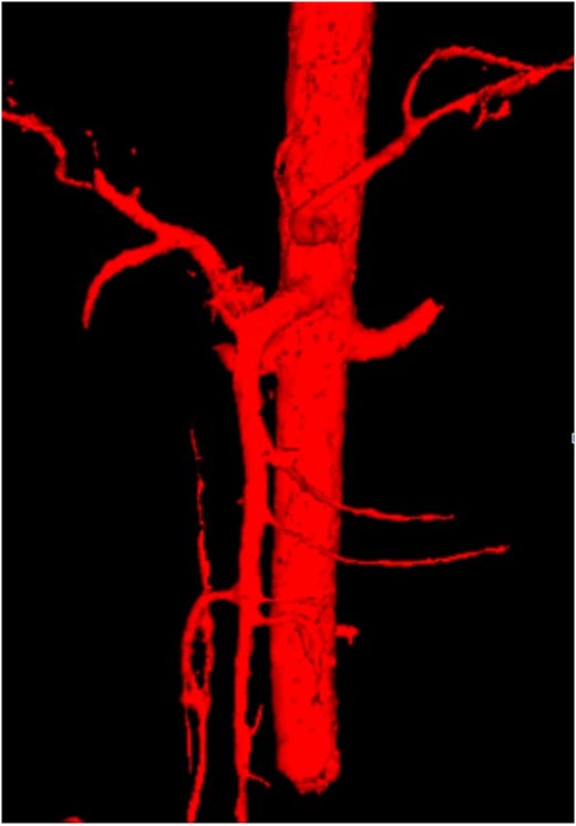 3D reconstruction using Myrian software illustrating the arterial anatomical variation.