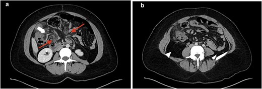 CT images. a: Small and large bowel (top arrow) herniating through omentum (bottom two arrows); b: Intra-abdominal fat displacing colon to the midline (arrowhead).