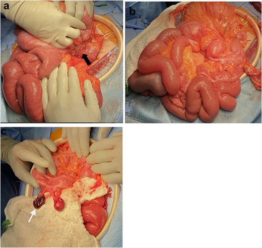 Intraoperative findings. a: Omental band around small bowel (black arrow), with herniation of non-ischemic bowel loops through it. b: Absent lateral attachment of ascending and descending colon. c: Necrotic epiploic appendage (white arrow).