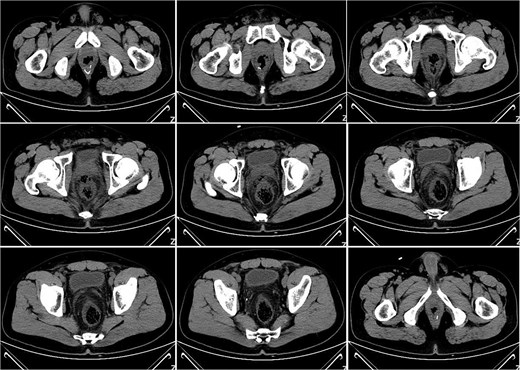 Pelvic CT on postoperative Day 7.