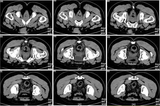 Pelvic CT on postoperative Day 10.