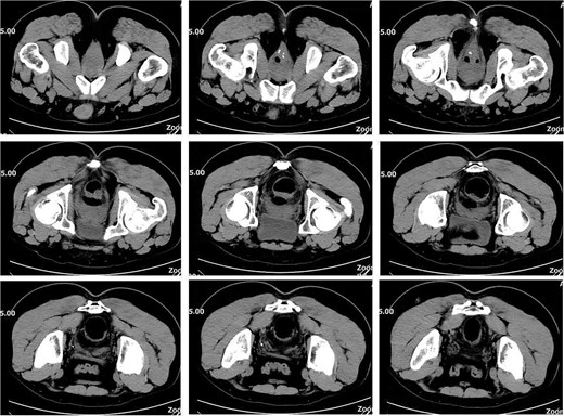 Pelvic CT on postoperative Day 15.