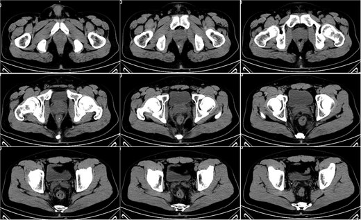 Pelvic CT on postoperative Day 21.