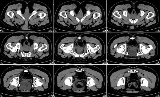 Pelvic CT on postoperative Day 28.