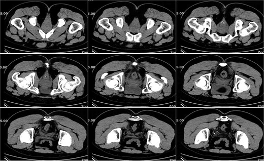 Pelvic CT on postoperative Day 49.