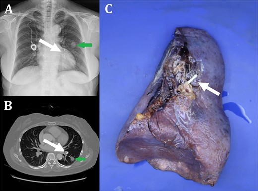 Fractured chemoport fragment embedded in left superior segmental pulmonary artery (white arrow) (A: Chest X-ray, B: Chest CT, C: Specimen of left lower lobe). Colloid adenocarcinoma in superior segment of left lower lobe (green arrow) (A: Chest X-ray, B: Chest CT).