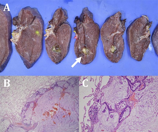 Serial sections of the lung reveal a circumscribed gelatinous tumor (white arrow) (A). The tumor shows prominent extracellular mucin pools with effacement of underlying lung parenchyma (B). The mucin pool is focally surrounded by tumor cells, which are columnar, pseudostratified epithelial cells exhibiting nuclear atypia (hematoxylin and eosin stain, ×100) (C).