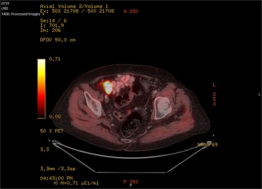 PET-CT scan showing FDG uptake at the recto-sigma junction seen as small bright spot in the middle of the screen.