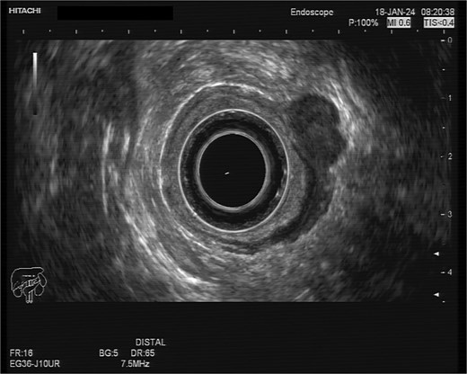 Radial sonographic view of the malignant lesion at the 2 o'clock position.