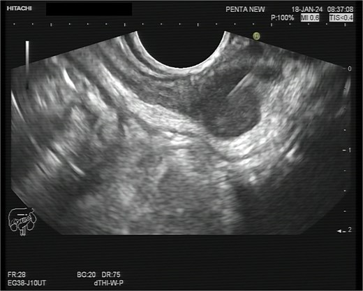 Linear view of the malignant lesion seen as a hypoechoeic mass with biopsy needle inside.