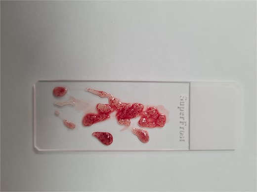 Whitish core material obtained by fine-needle biopsy embedded on a slide before submission to pathological evaluation.