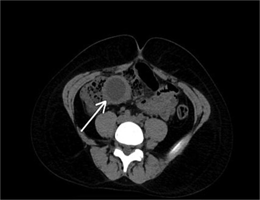 A preoperative axial CT scan of the abdomen and pelvis demonstrates a well-defined, fluid-filled cystic structure adjacent to the bowel.
