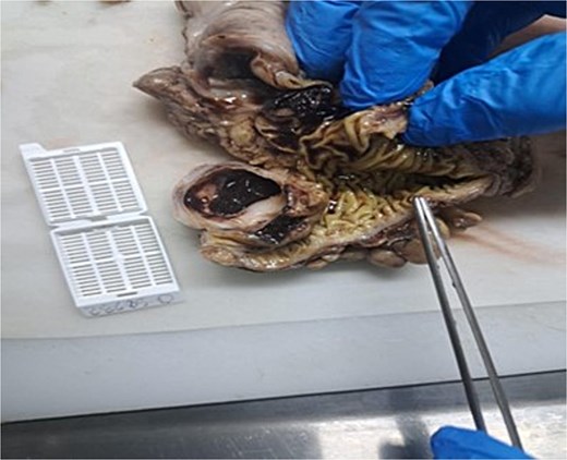 View of duplicated cyst post-surgical resection.