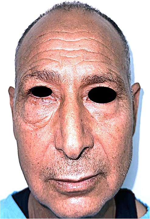 Frontal view of the patient showing a discrete, well-demarcated lower eyelid swelling without skin changes or ulceration.