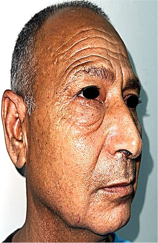Lateral profile of the patient demonstrating the extent of the painless lower eyelid mass.