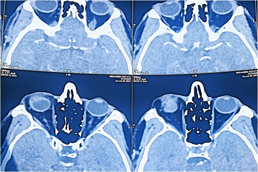 Axial CT scan (soft tissue window) revealing a well-defined, ovoid lesion with peripheral contrast enhancement in the inferior orbital region.