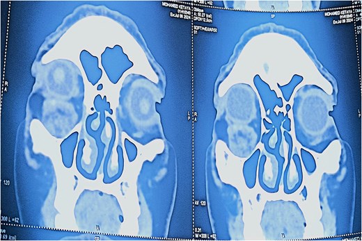 Coronal CT scan showing the subcutaneous location of the tumor with no invasion of adjacent structures.