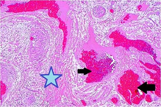 Histopathological examination with hematoxylin and eosin staining shows muscular components (marked with a star) and vascular components (marked with arrows).