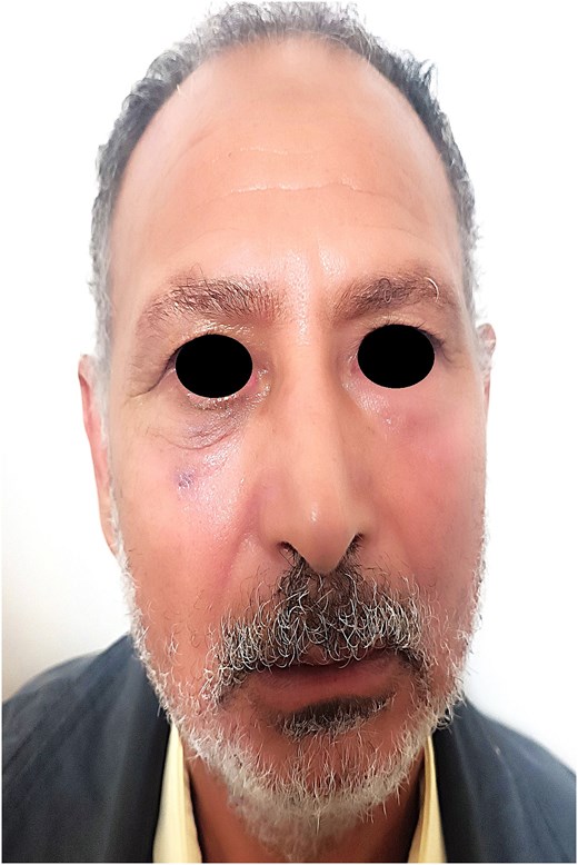 Postoperative frontal view of the patient at 1-year follow-up, showing excellent esthetic and functional outcome with no recurrence.