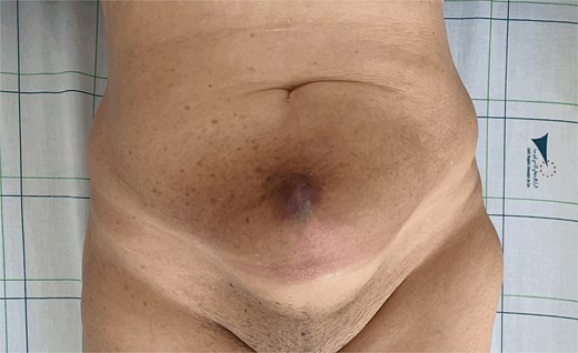 Mass at the previous trocar site with inflammatory signs.