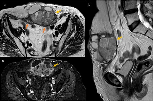Pelvic MRI in axial T2 (a), sagittal T2 (b), and axial T1 post-contrast (c), showing a well-defined mass at the trocar site, infiltrating the rectus abdominis muscles. The mass has regular contours, heterogeneous content with both fluid and tissue components, and exhibits enhancement after contrast injection.