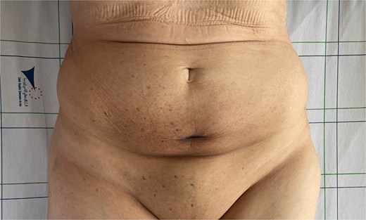 Clinical regression of the mass and disappearance of inflammatory signs after the third cycle of chemotherapy.