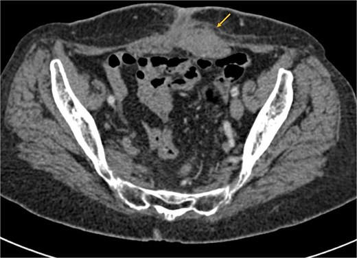 Axial CT scan showing a significant reduction in the size of the mass post-chemotherapy, now confined to the left rectus abdominis muscle with fat infiltration.