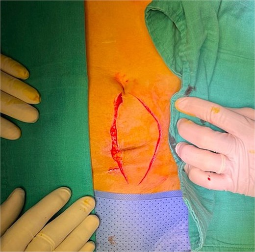 Initial skin incision. The incision was later extended on the left to ensure adequate safety margins.