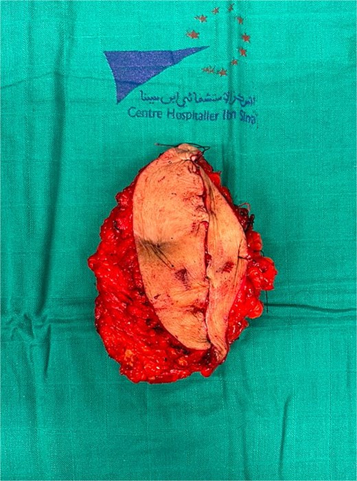 Surgical specimen.
