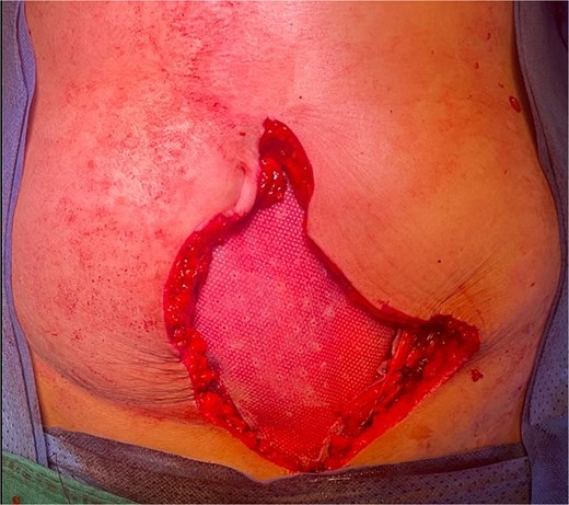 Abdominal wall reconstruction with a dual mesh.