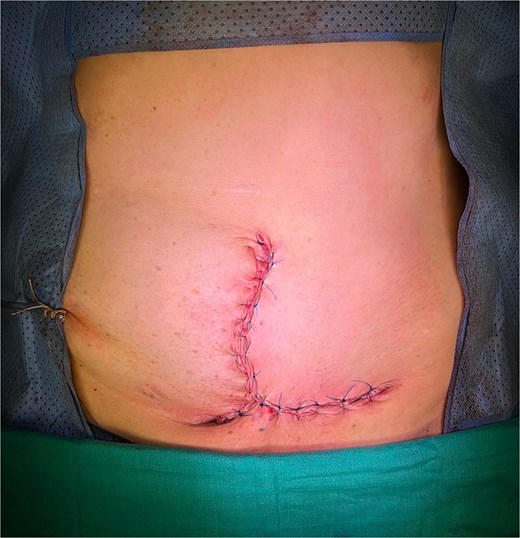 Appearance of the abdominal scar following the procedure.