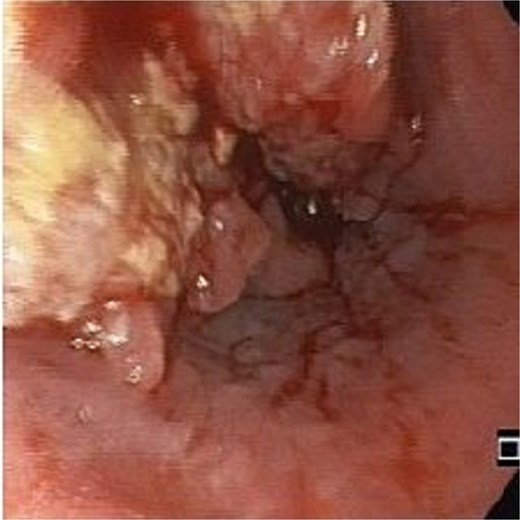 The primary esophageal tumor.