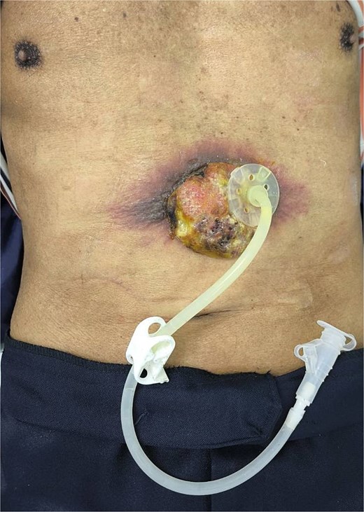 A large abdominal wall mass adjacent to the PEG tube site.