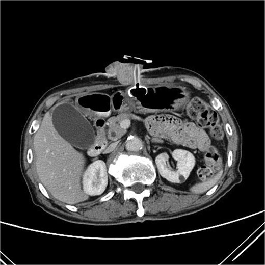 A CT scan of the abdomen showed a 6.2 x 5.6 cm enhancing soft tissue mass in the anterior abdominal wall.