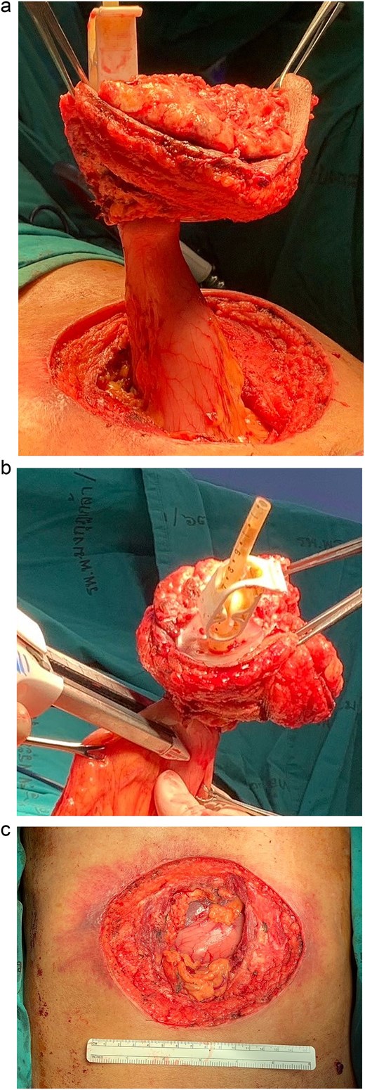 Operative procedure: (a) the mass and the PEG tube were dissected from the abdominal wall, (b) transected the stomach with surgical stapling devices, and (c) the abdominal wall defect.