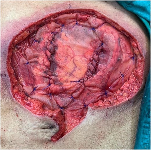 An inter-layer polyglactin mesh repair.