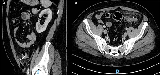 CT of the abdomen and pelvic with contrast, demonstrating an ingested foreign body with localized perforation and pericolic inflammatory changes, in both (A) sagittal view and (B) axial view.